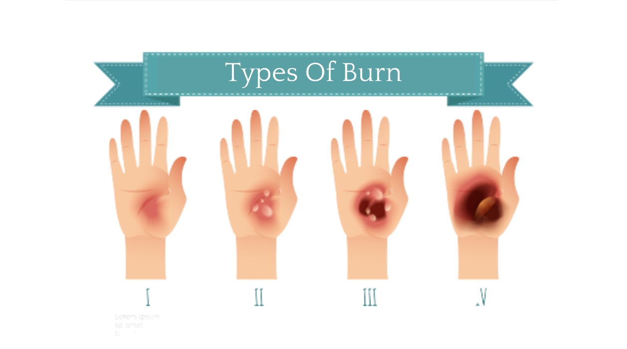 Image showing different types of burns